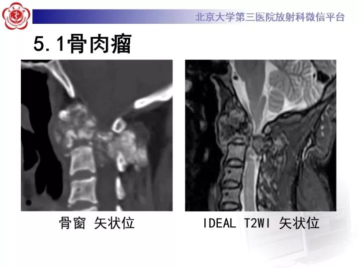【病例】胸椎软骨肉瘤1例CT及MR影像表现