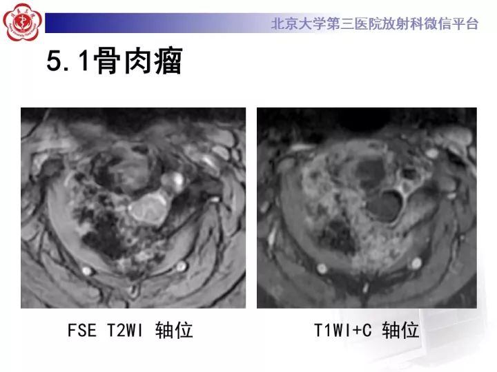 【病例】胸椎软骨肉瘤1例CT及MR影像表现