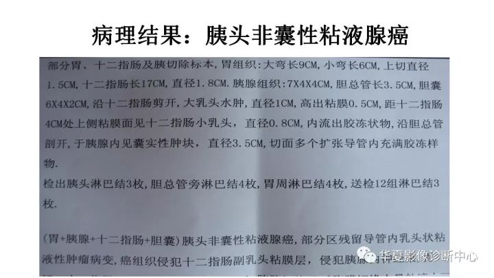 【病例】胰腺粘液腺癌1例CT影像表现