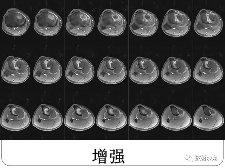 【病例】胫骨骨肉瘤1例X线CT及MR影像表现