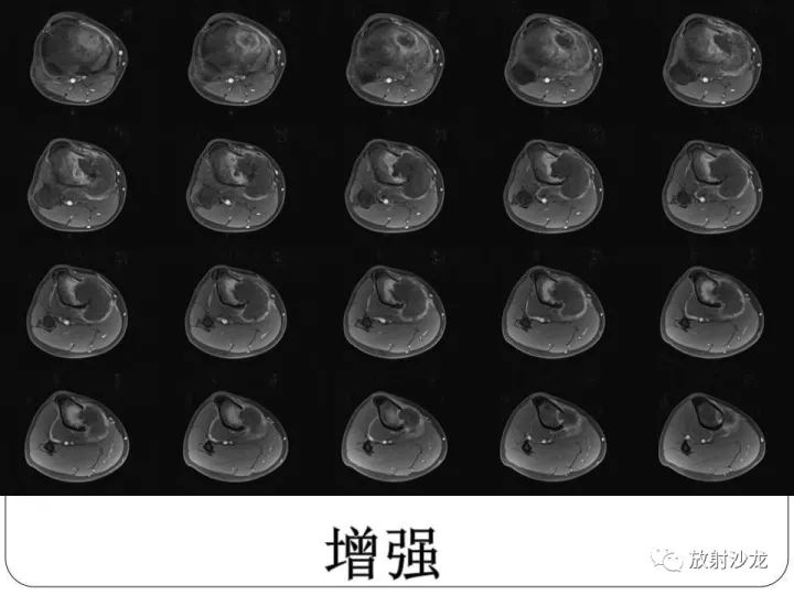 【病例】胫骨骨肉瘤1例X线CT及MR影像表现