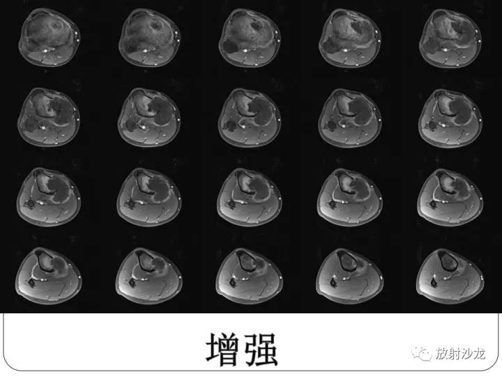 【病例】胫骨骨肉瘤1例X线CT及MR影像表现