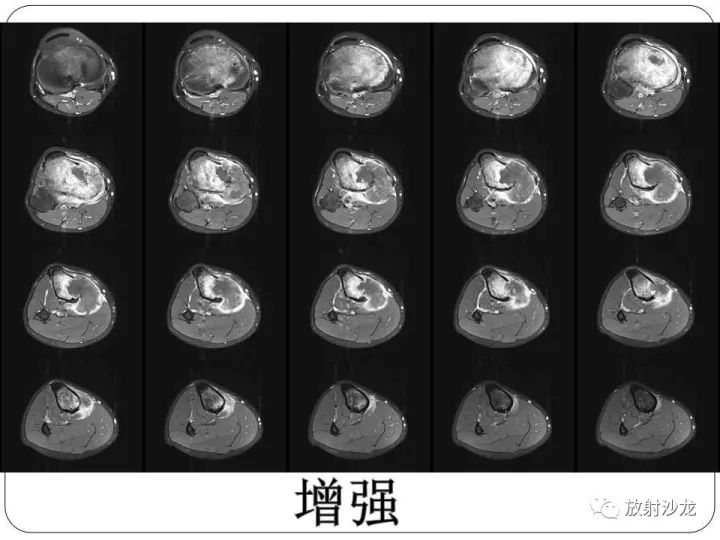 【病例】胫骨骨肉瘤1例X线CT及MR影像表现