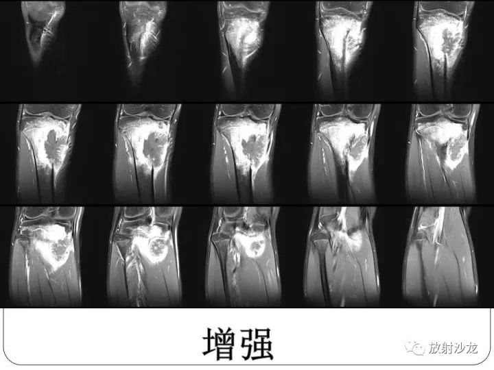 【病例】胫骨骨肉瘤1例X线CT及MR影像表现