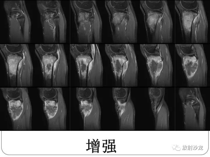 【病例】胫骨骨肉瘤1例X线CT及MR影像表现