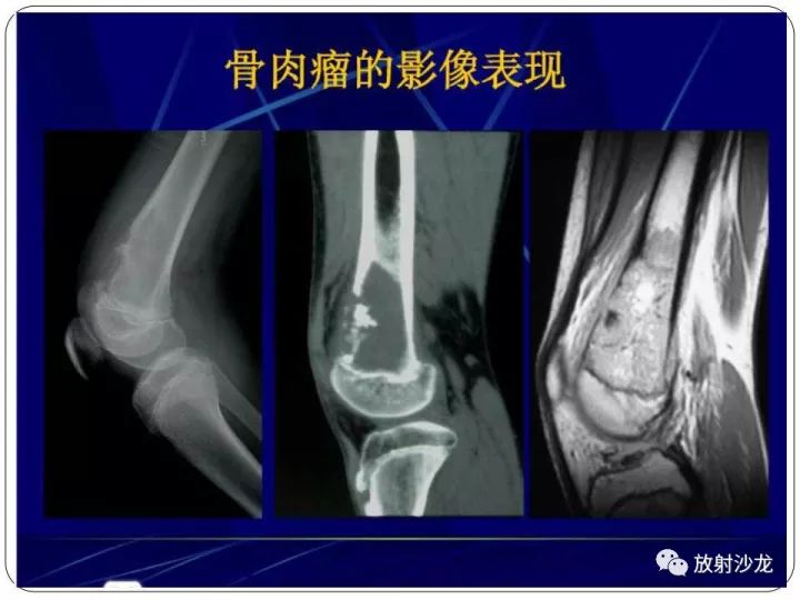 【病例】胫骨骨肉瘤1例X线CT及MR影像表现