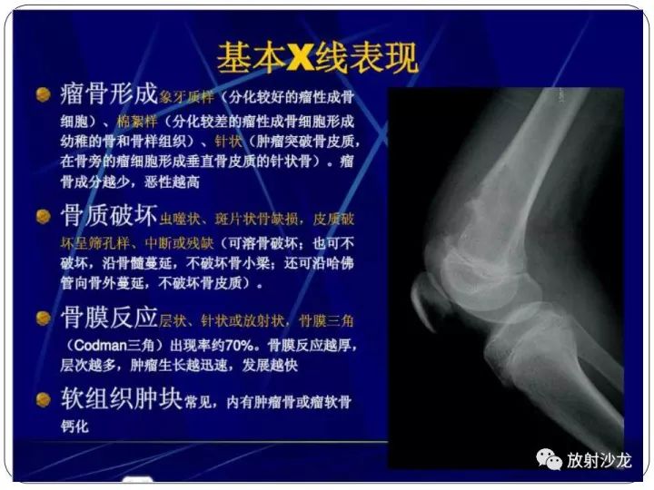 【病例】胫骨骨肉瘤1例X线CT及MR影像表现