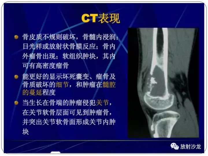 【病例】胫骨骨肉瘤1例X线CT及MR影像表现