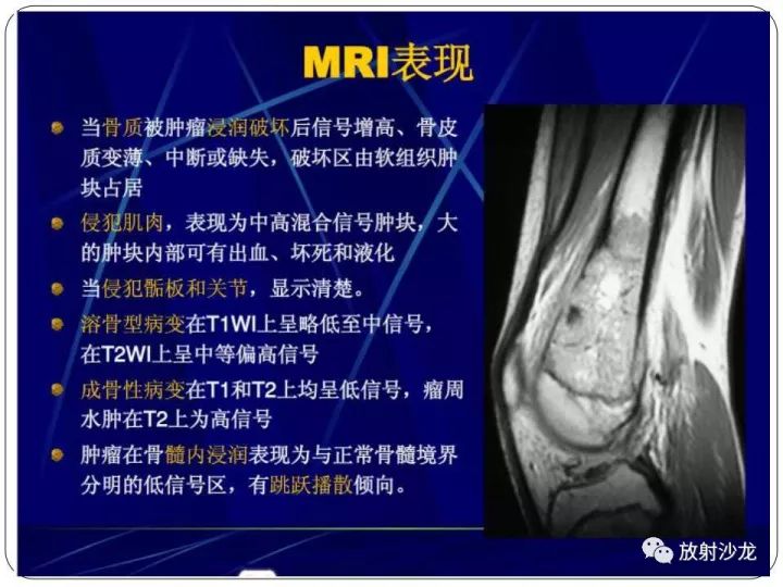 【病例】胫骨骨肉瘤1例X线CT及MR影像表现