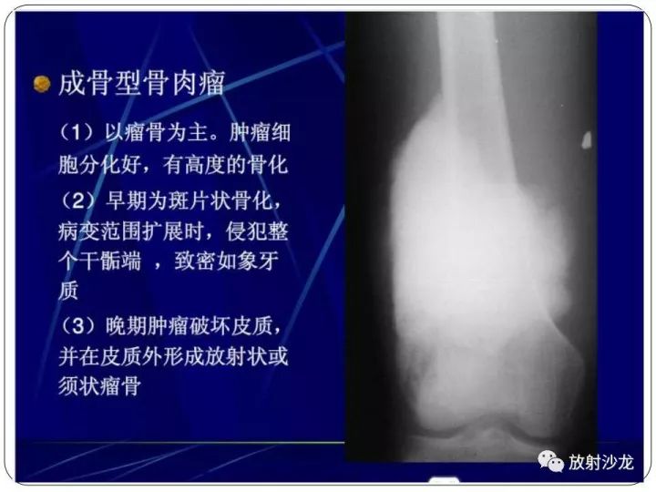 【病例】胫骨骨肉瘤1例X线CT及MR影像表现