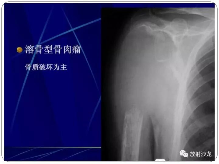 【病例】胫骨骨肉瘤1例X线CT及MR影像表现
