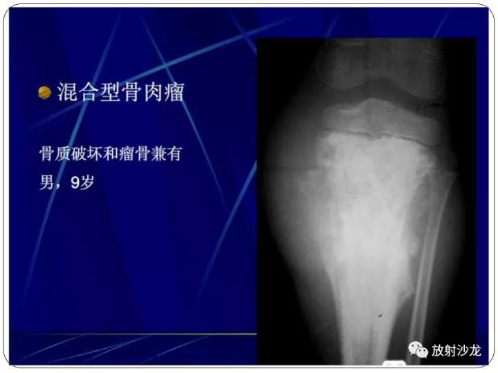 【病例】胫骨骨肉瘤1例X线CT及MR影像表现