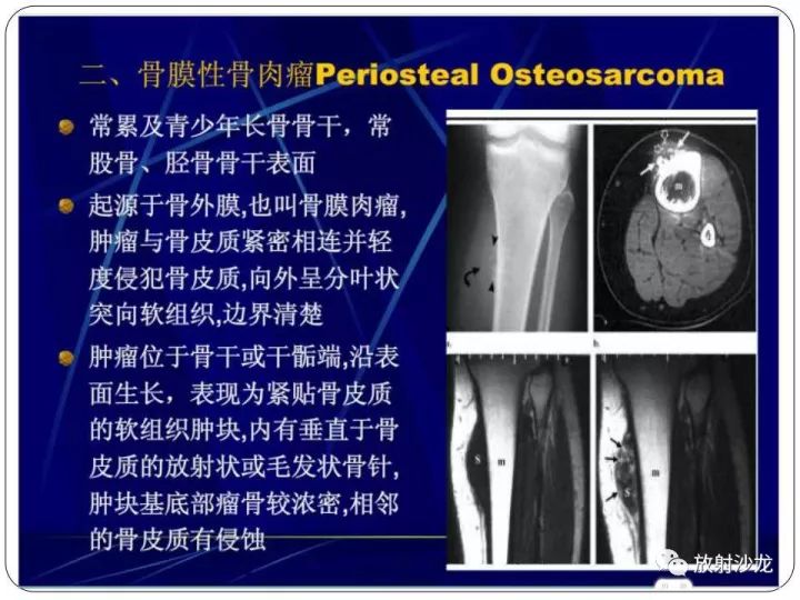 【病例】胫骨骨肉瘤1例X线CT及MR影像表现