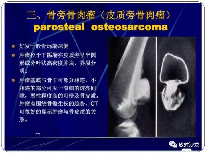 【病例】胫骨骨肉瘤1例X线CT及MR影像表现