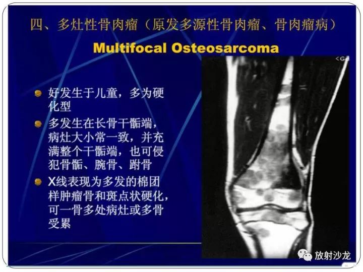 【病例】胫骨骨肉瘤1例X线CT及MR影像表现