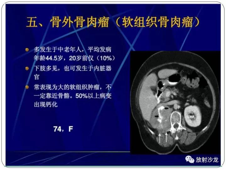 【病例】胫骨骨肉瘤1例X线CT及MR影像表现