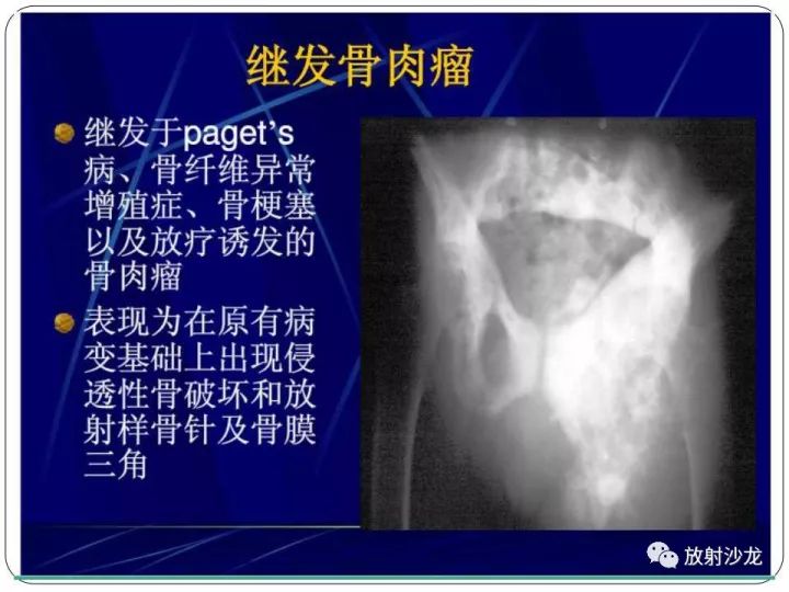 【病例】胫骨骨肉瘤1例X线CT及MR影像表现