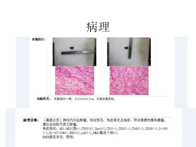 【病例】侵袭性垂体瘤1例CT及MR影像表现