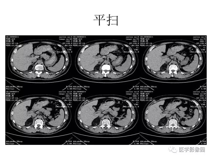 【病例】肾上腺血管平滑肌脂肪瘤1例CT影像表现