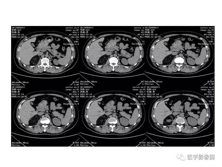 【病例】肾上腺血管平滑肌脂肪瘤1例CT影像表现