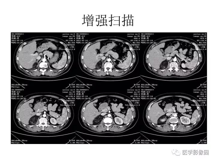 【病例】肾上腺血管平滑肌脂肪瘤1例CT影像表现