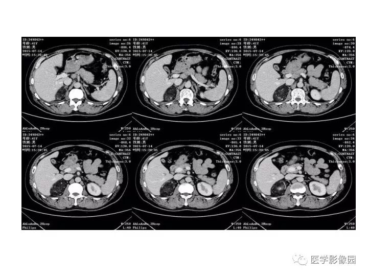 【病例】肾上腺血管平滑肌脂肪瘤1例CT影像表现
