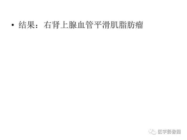 【病例】肾上腺血管平滑肌脂肪瘤1例CT影像表现