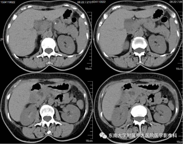 【病例】胰腺导管内乳头状黏液性肿瘤1例CT及MR