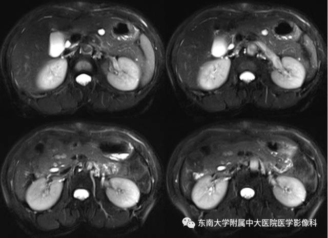 【病例】胰腺导管内乳头状黏液性肿瘤1例CT及MR