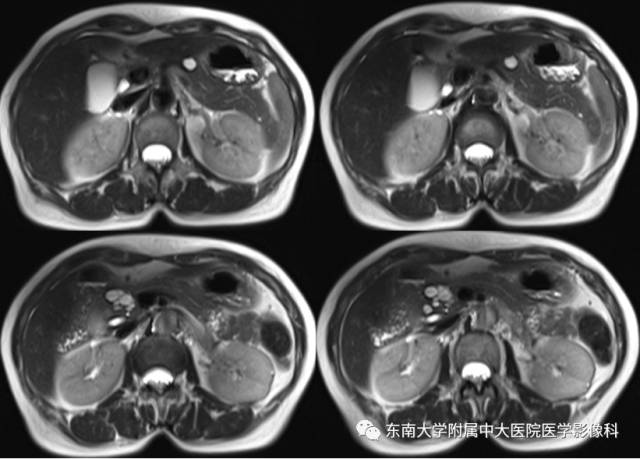 【病例】胰腺导管内乳头状黏液性肿瘤1例CT及MR