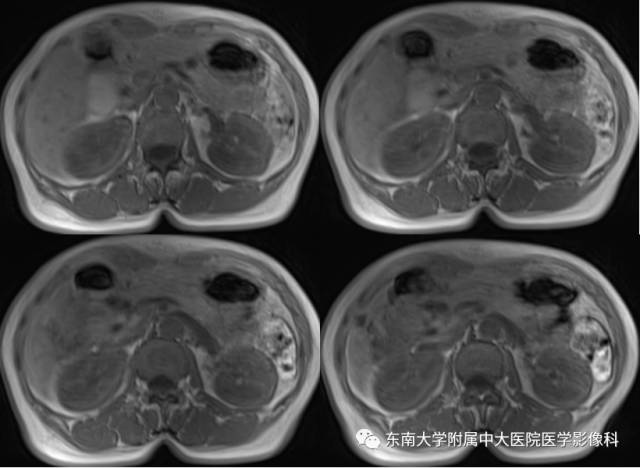 【病例】胰腺导管内乳头状黏液性肿瘤1例CT及MR