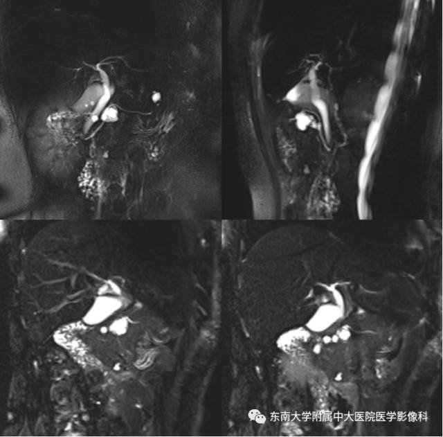 【病例】胰腺导管内乳头状黏液性肿瘤1例CT及MR
