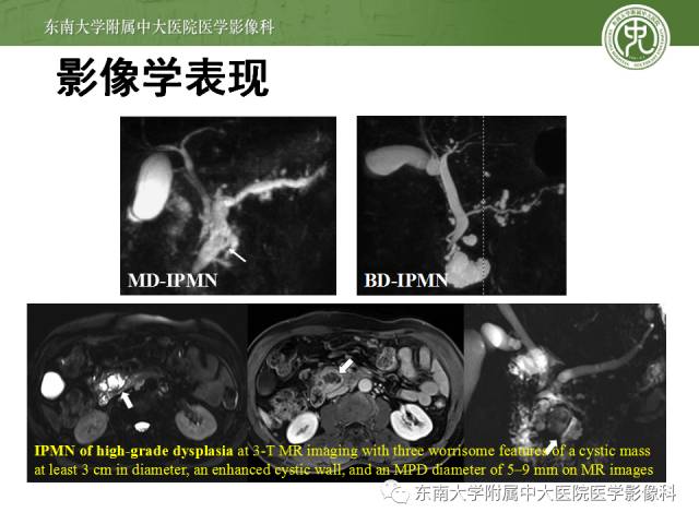 【病例】胰腺导管内乳头状黏液性肿瘤1例CT及MR