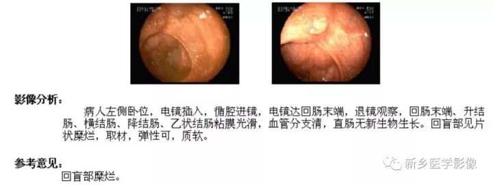 【病例】肠结核1例CT影像表现