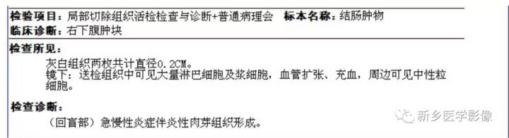 【病例】肠结核1例CT影像表现
