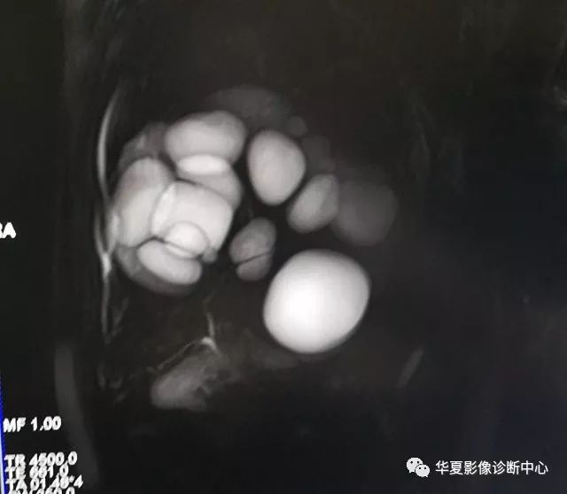 包虫居然可以长在这些地方 包虫居然可以长在这些地方