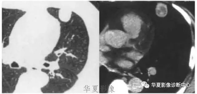 包虫居然可以长在这些地方 包虫居然可以长在这些地方