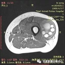 包虫居然可以长在这些地方 包虫居然可以长在这些地方