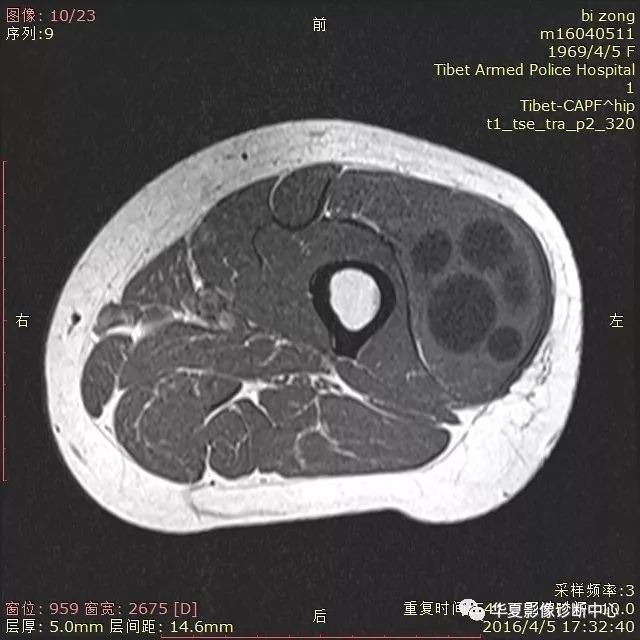 包虫居然可以长在这些地方