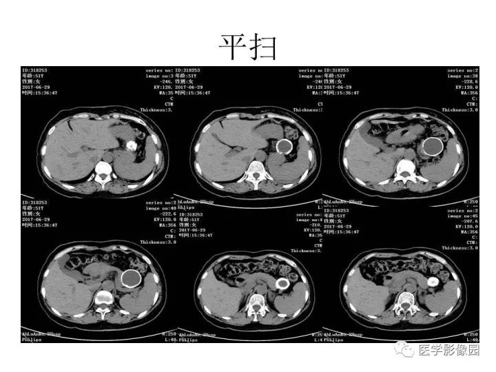 【病例】胰腺假性囊肿伴钙化1例CT影像表现