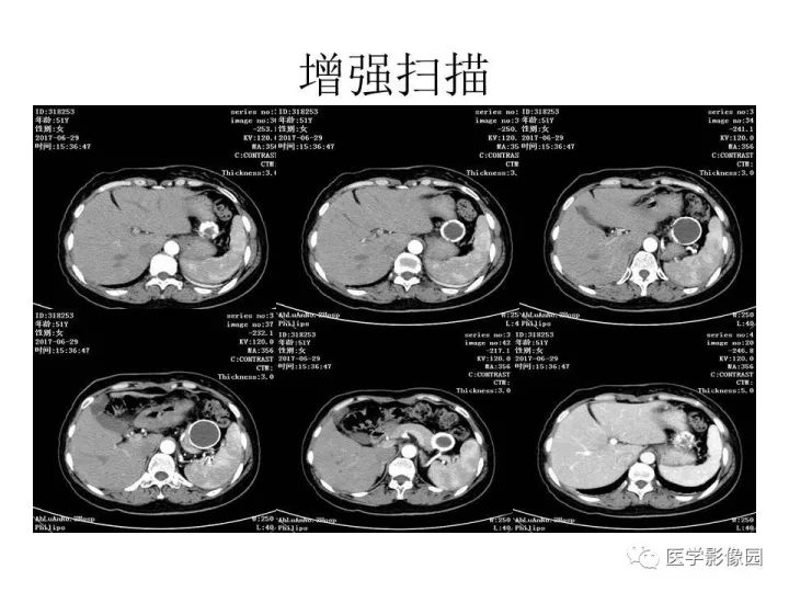 【病例】胰腺假性囊肿伴钙化1例CT影像表现