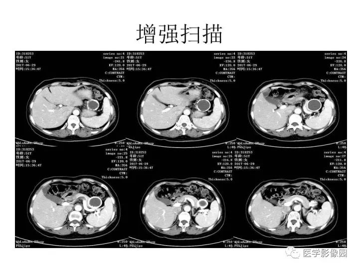 【病例】胰腺假性囊肿伴钙化1例CT影像表现
