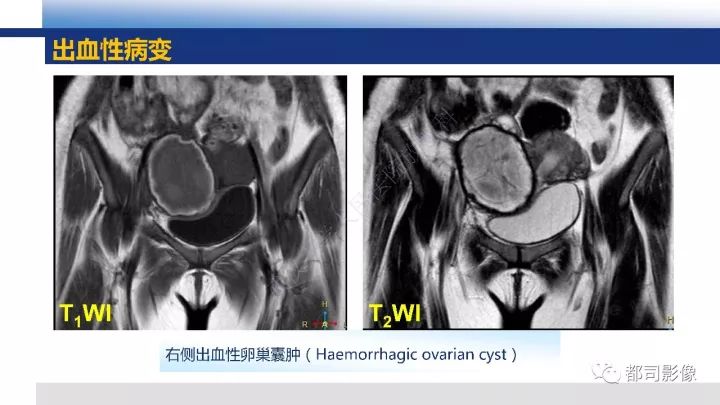 【PPT】女性生殖系统T2WI低信号病变影像诊断