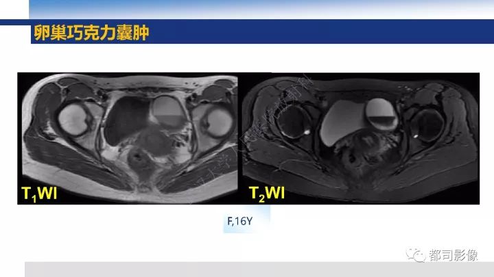 【PPT】女性生殖系统T2WI低信号病变影像诊断