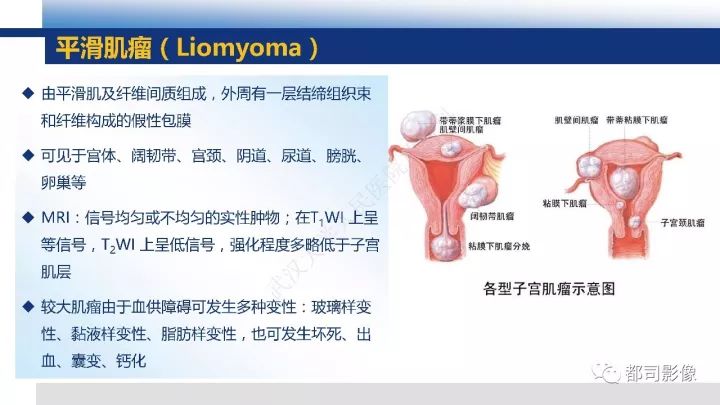 【PPT】女性生殖系统T2WI低信号病变影像诊断