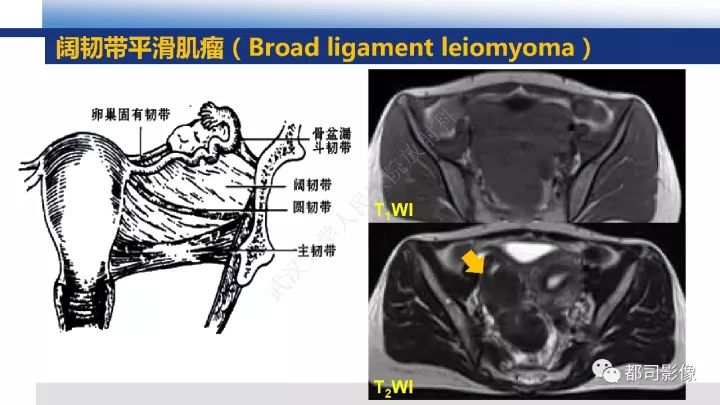 【PPT】女性生殖系统T2WI低信号病变影像诊断