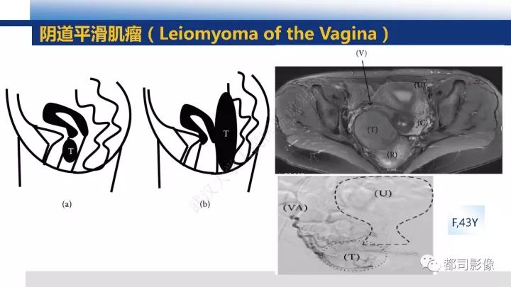 【PPT】女性生殖系统T2WI低信号病变影像诊断