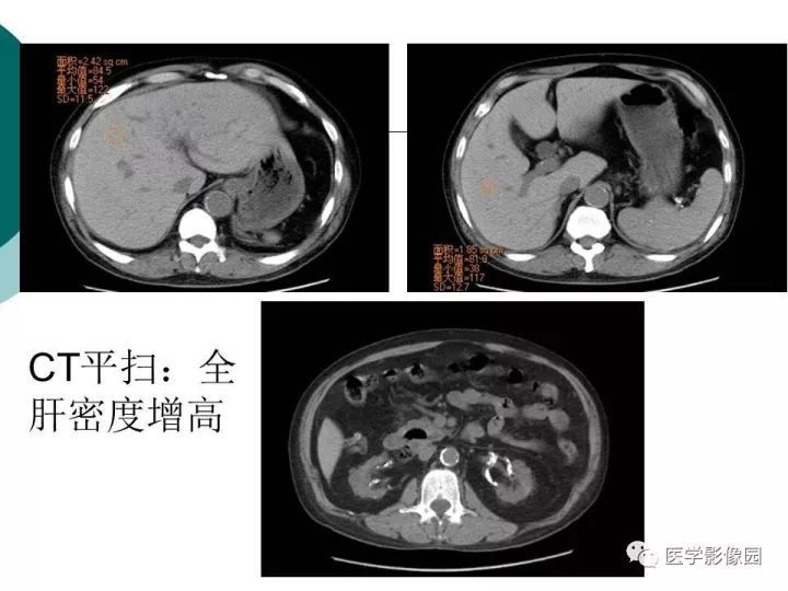 【病例】肝血色素病1例CT及MR影像表现