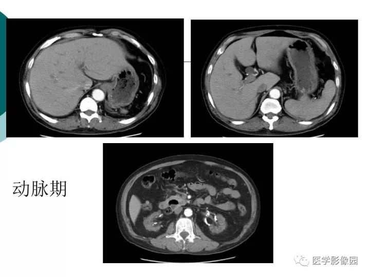 【病例】肝血色素病1例CT及MR影像表现