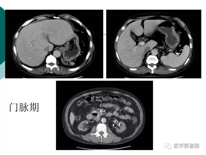 【病例】肝血色素病1例CT及MR影像表现